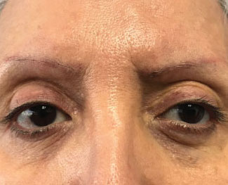 Blepharoplasty Before & After Image