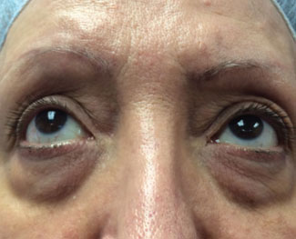 Blepharoplasty Before & After Image