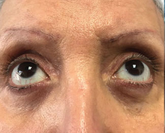 Blepharoplasty Before & After Image