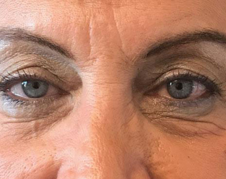 Blepharoplasty Before & After Image