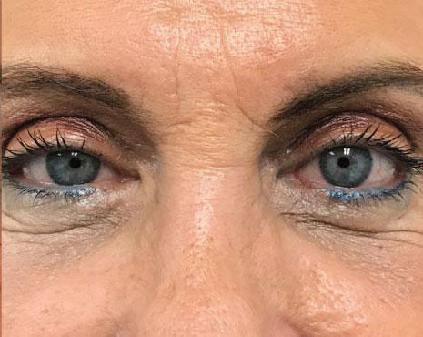 Blepharoplasty Before & After Image