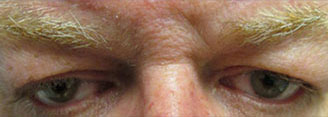 Blepharoplasty Before & After Image