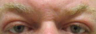 Blepharoplasty Before & After Image