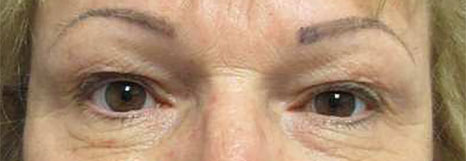 Blepharoplasty Before & After Image