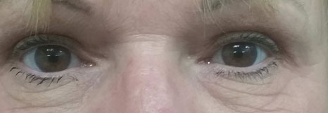 Blepharoplasty Before & After Image