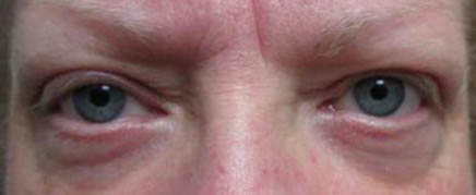 Blepharoplasty Before & After Image