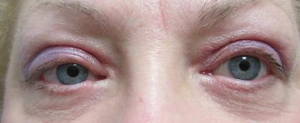 Blepharoplasty Before & After Image