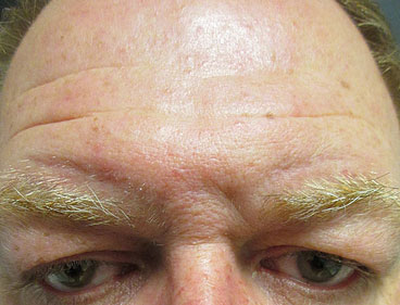 Brow Lift Before & After Image