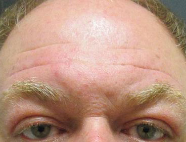 Brow Lift Before & After Image