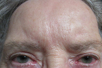 Brow Lift Before & After Image