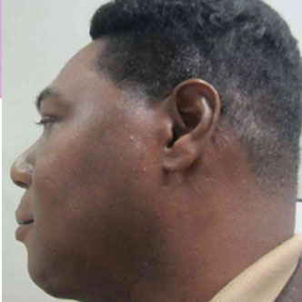 Chin Augmentation Before & After Image