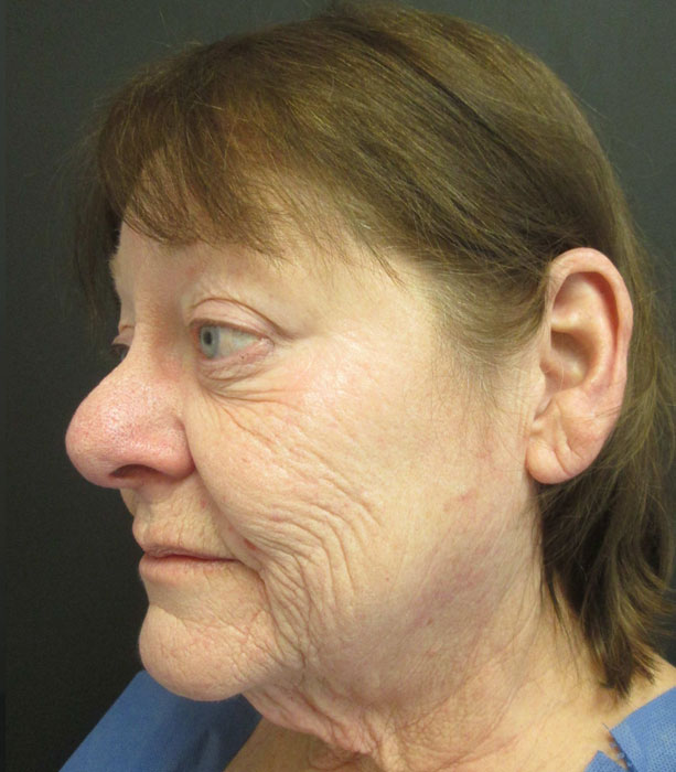 Mak Lift Face Lift Before & After Image