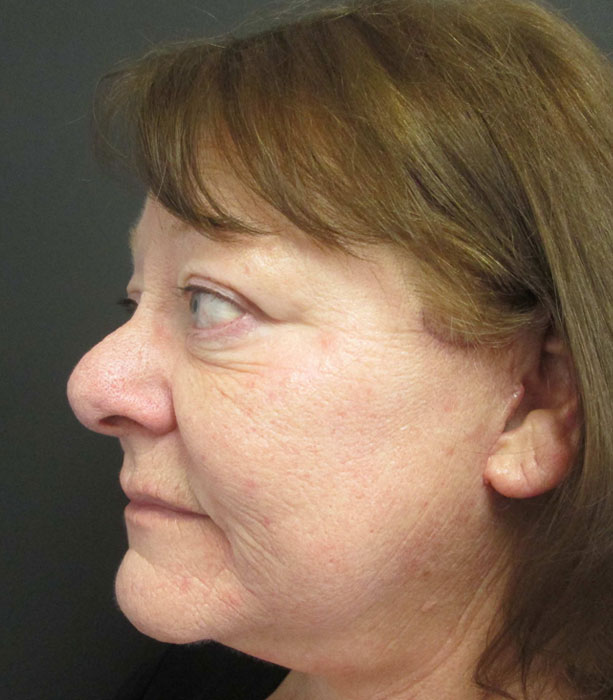 Mak Lift Face Lift Before & After Image