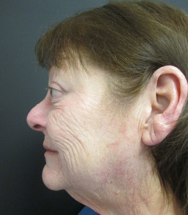 Mak Lift Face Lift Before & After Image