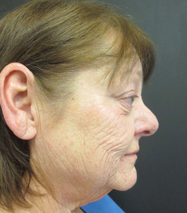 Mak Lift Face Lift Before & After Image