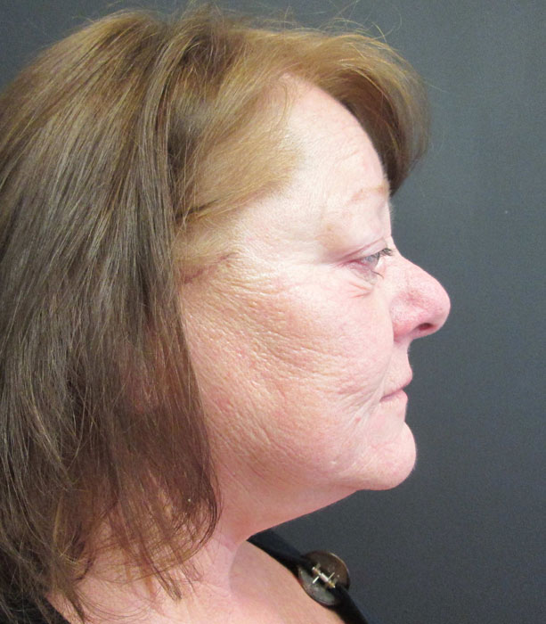 Mak Lift Face Lift Before & After Image