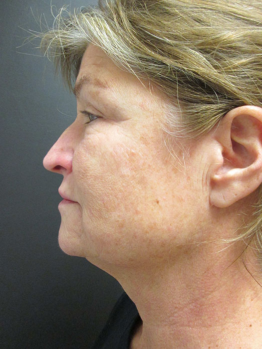 Mak Lift Face Lift Before & After Image