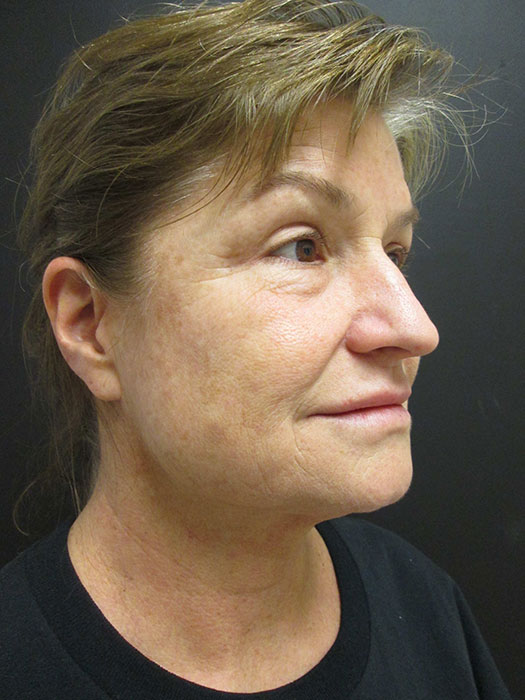 Mak Lift Face Lift Before & After Image