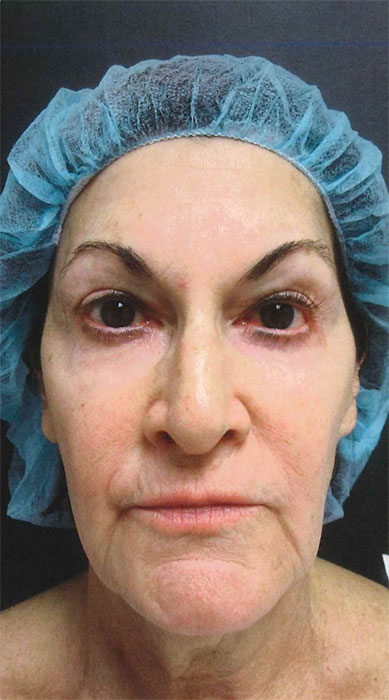 Mak Lift Face Lift Before & After Image