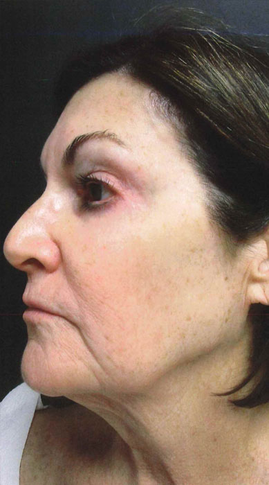 Mak Lift Face Lift Before & After Image