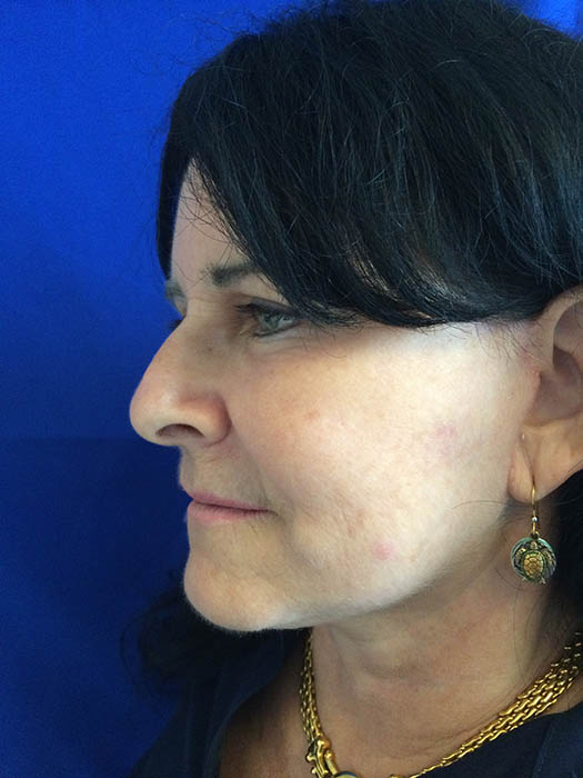 Mak Lift Face Lift Before & After Image