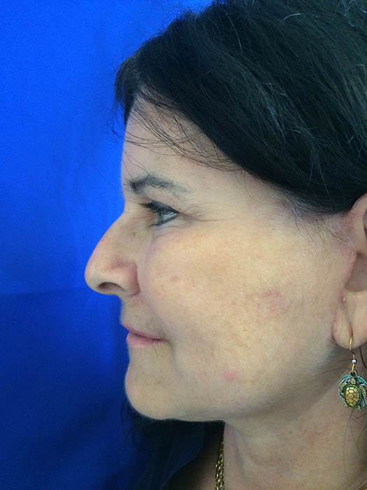 Mak Lift Face Lift Before & After Image