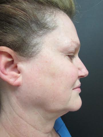 Mak Lift Face Lift Before & After Image