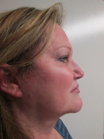 Mak Lift Face Lift Before & After Image