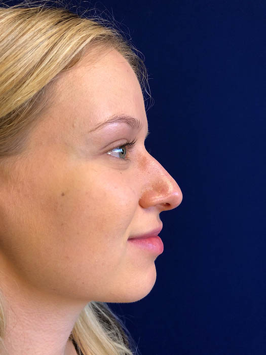 Rhinoplasty Before & After Image