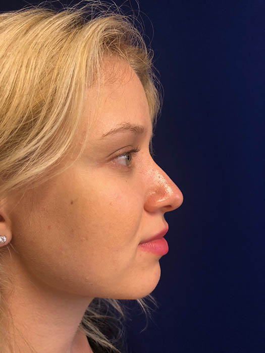 Rhinoplasty Before & After Image