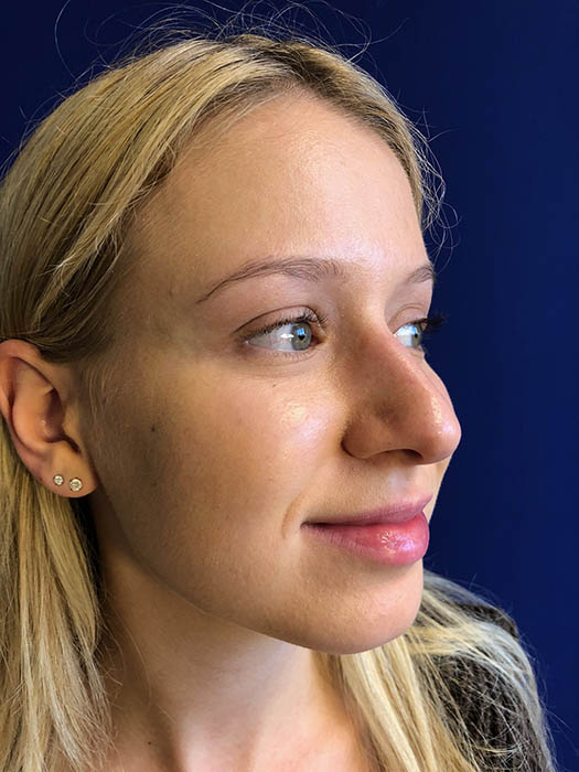 Rhinoplasty Before & After Image