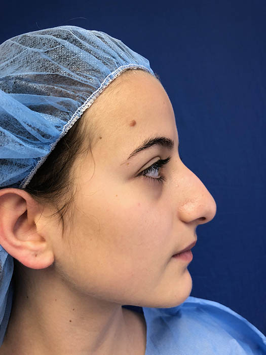 Rhinoplasty Before & After Image