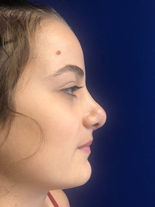 Rhinoplasty Before & After Image