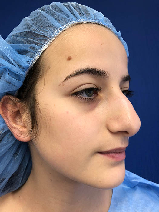 Rhinoplasty Before & After Image