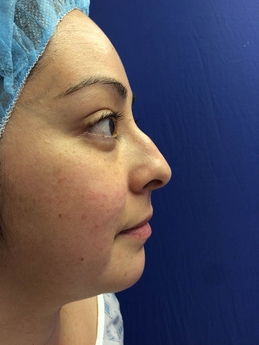 Rhinoplasty Before & After Image