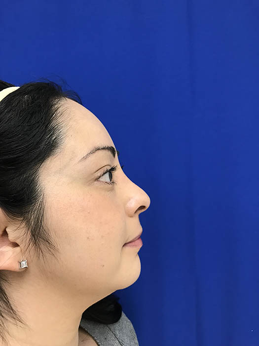 Rhinoplasty Before & After Image