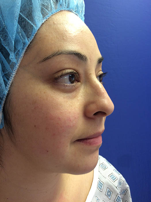 Rhinoplasty Before & After Image