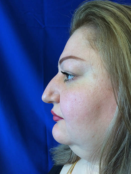 Rhinoplasty Before & After Image