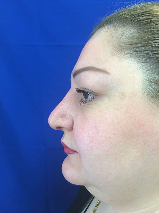 Rhinoplasty Before & After Image