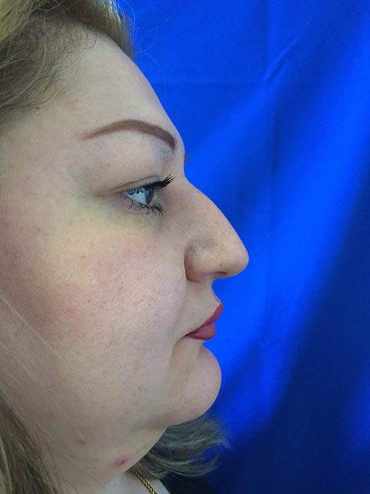 Rhinoplasty Before & After Image