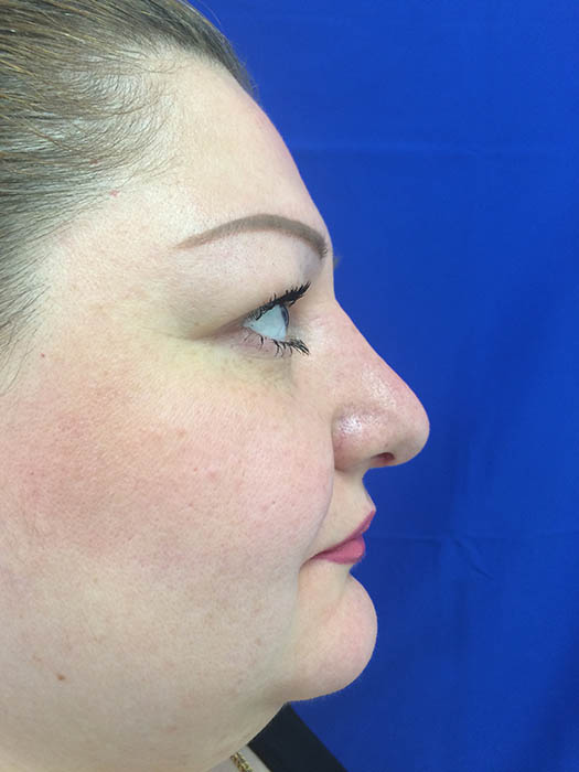 Rhinoplasty Before & After Image