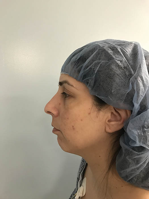 Rhinoplasty Before & After Image