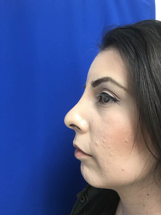 Rhinoplasty Before & After Image