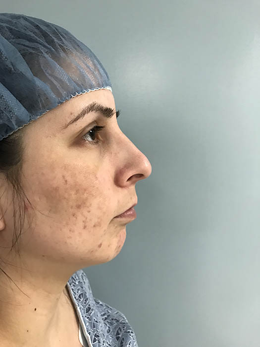 Rhinoplasty Before & After Image