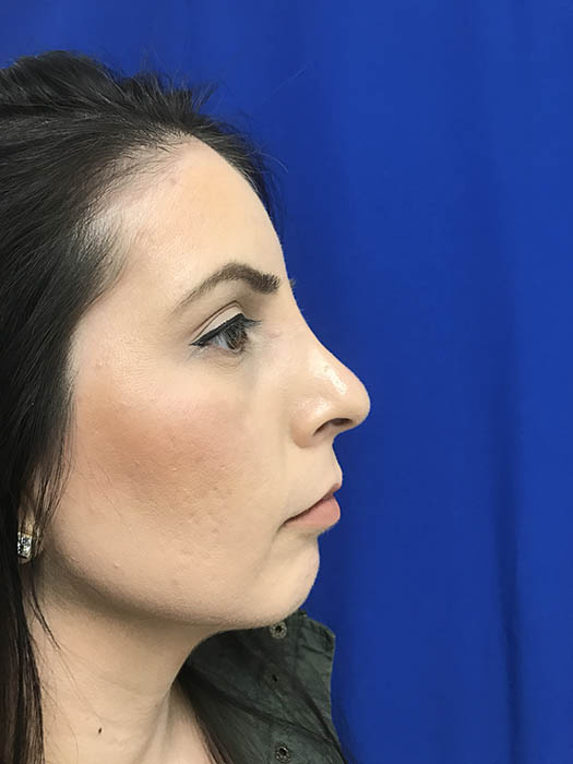 Rhinoplasty Before & After Image