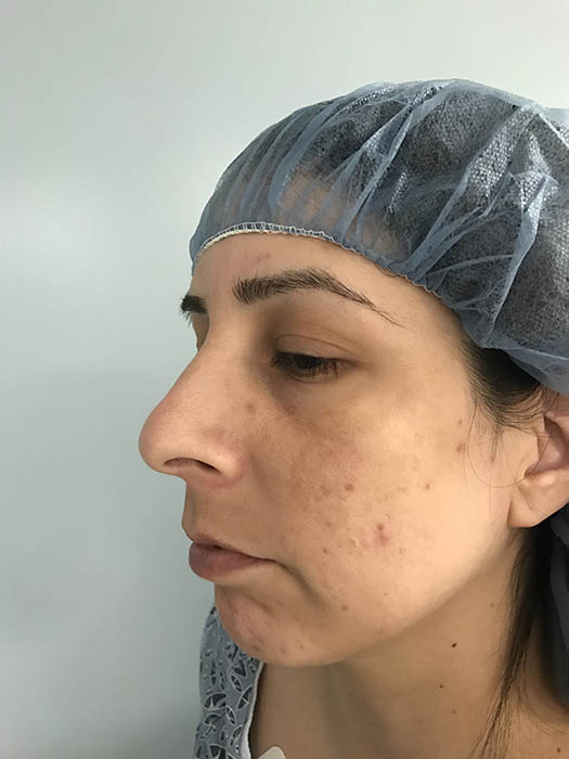 Rhinoplasty Before & After Image