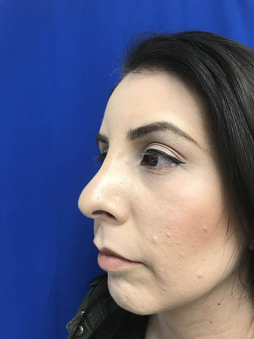 Rhinoplasty Before & After Image