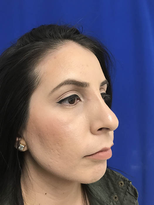 Rhinoplasty Before & After Image