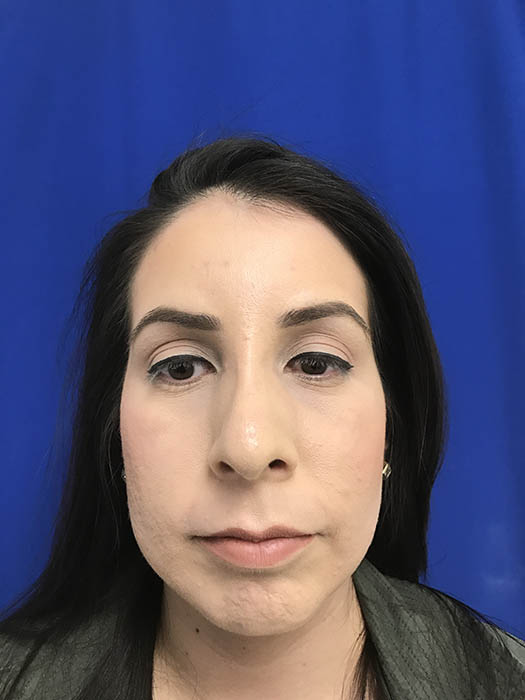 Rhinoplasty Before & After Image