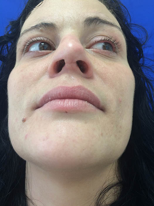 Rhinoplasty Before & After Image